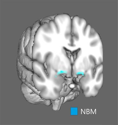 Reduction in Volume of Nucleus Basalis of Meynert Is Specific to Parkinson’s Disease and Progressive Supranuclear Palsy but Not to Multiple System Atrophy